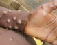 Monkeypox virus: Four new cases; warning signs to watch out for
