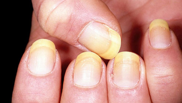 What causes yellow nails and how to cure this problem