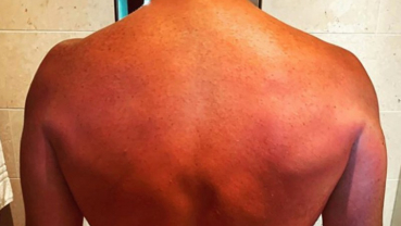 Chris Pratt shows off post-honeymoon sunburns
