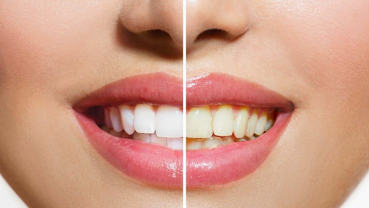 Myth Busters: Dental myths debunked