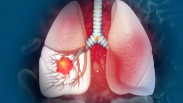 Lung Cancer Symptoms: Many Patients Experience Pain In These Parts Of The Face