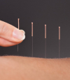A tale of acupuncture cure