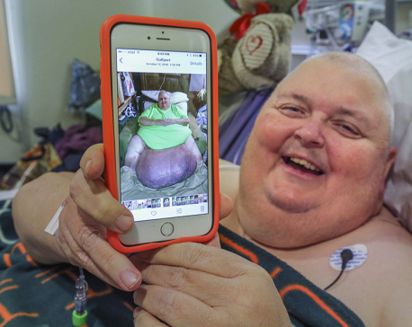 Doctor removes 130-pound tumor from Mississippi man