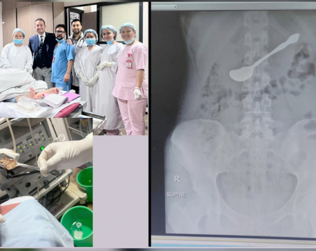 Doctors remove spoon stuck in abdomen without performing surgery