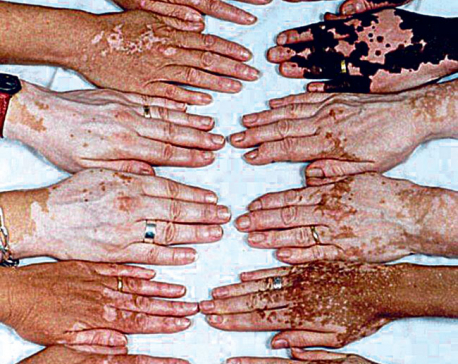 Demystifying Vitiligo