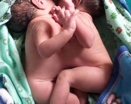 Conjoint twin girls born in Surkhet