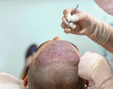 Chitwan Medical College offers bank loan for hair transplant