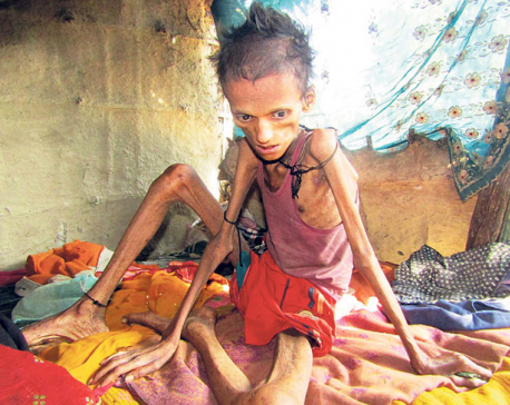 Malnutrition still rife in Karnali children