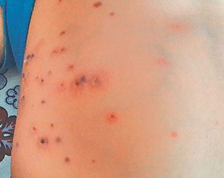 Scrub typhus cases increasing in Baitadi