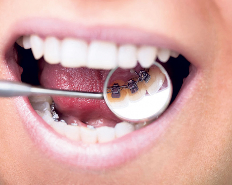 The basics of braces