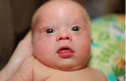 Down Syndrome: An Understanding through Prenatal Screening Tests