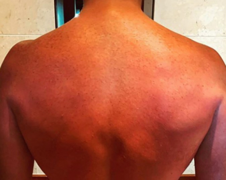 Chris Pratt shows off post-honeymoon sunburns