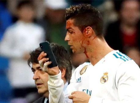 Ronaldo borrows doctor's phone to check facial injury on pitch