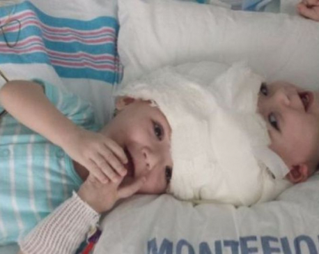 Conjoined twins successfully separated in 20-hr surgery