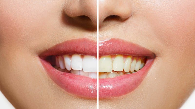 Myth Busters: Dental myths debunked