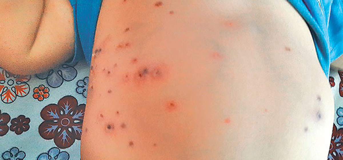 Health ministry warns of Scrub typhus which has symptoms similar to COVID-19