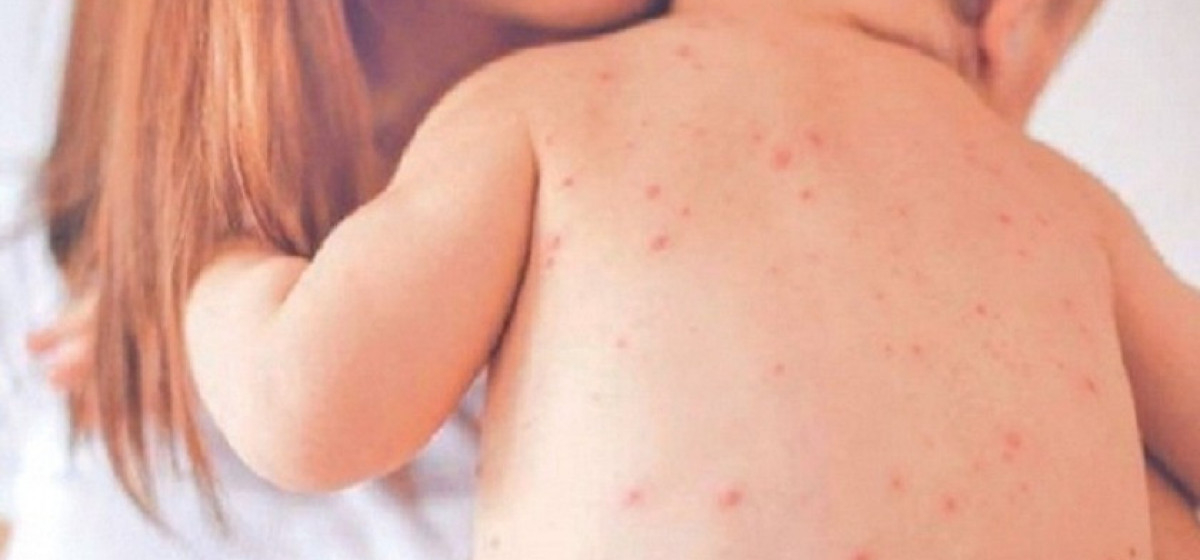 Measles spreads in 16 districts