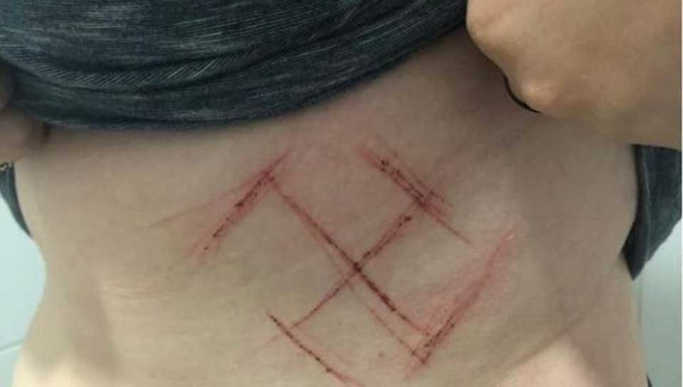 Brazil: Woman wearing #NotHim T-shirt attacked by Bolsonaro supporters, Swastika carved into skin