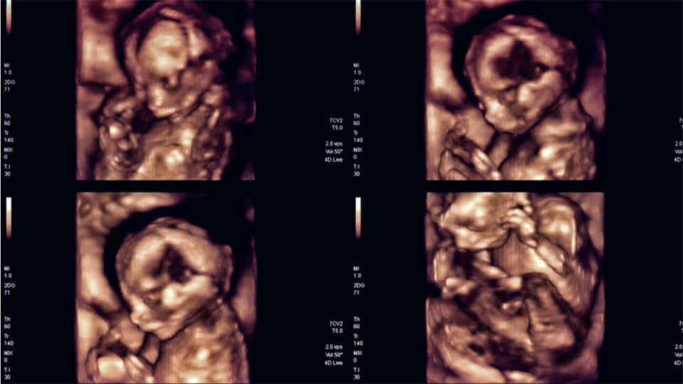 Autism Appears Unrelated To Ultrasounds During Pregnancy