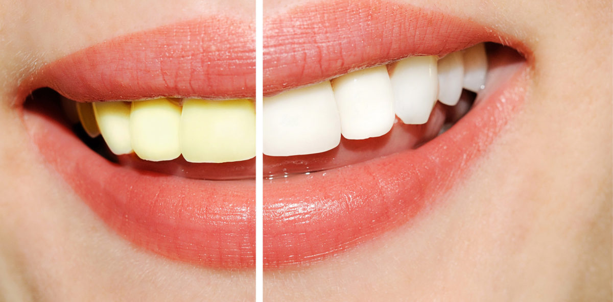 Try these food items to whiten your teeth naturally!