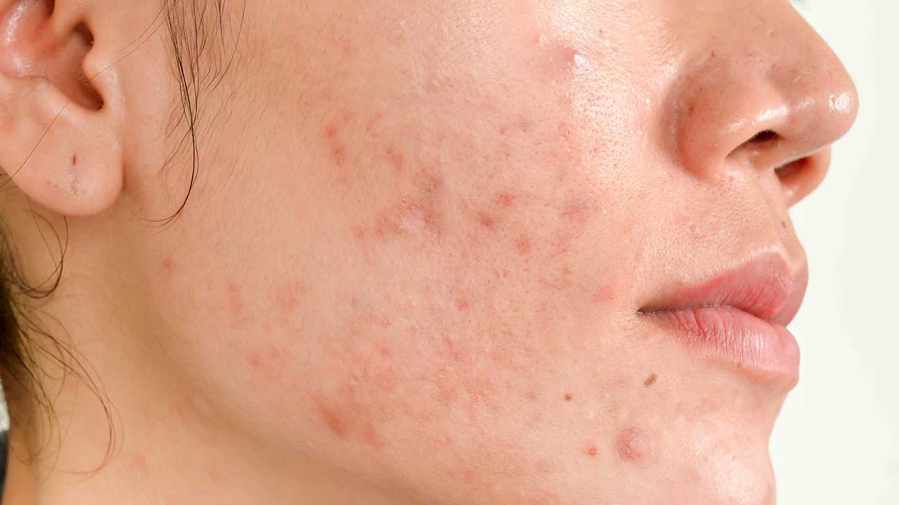 Tips to get rid of acne scars