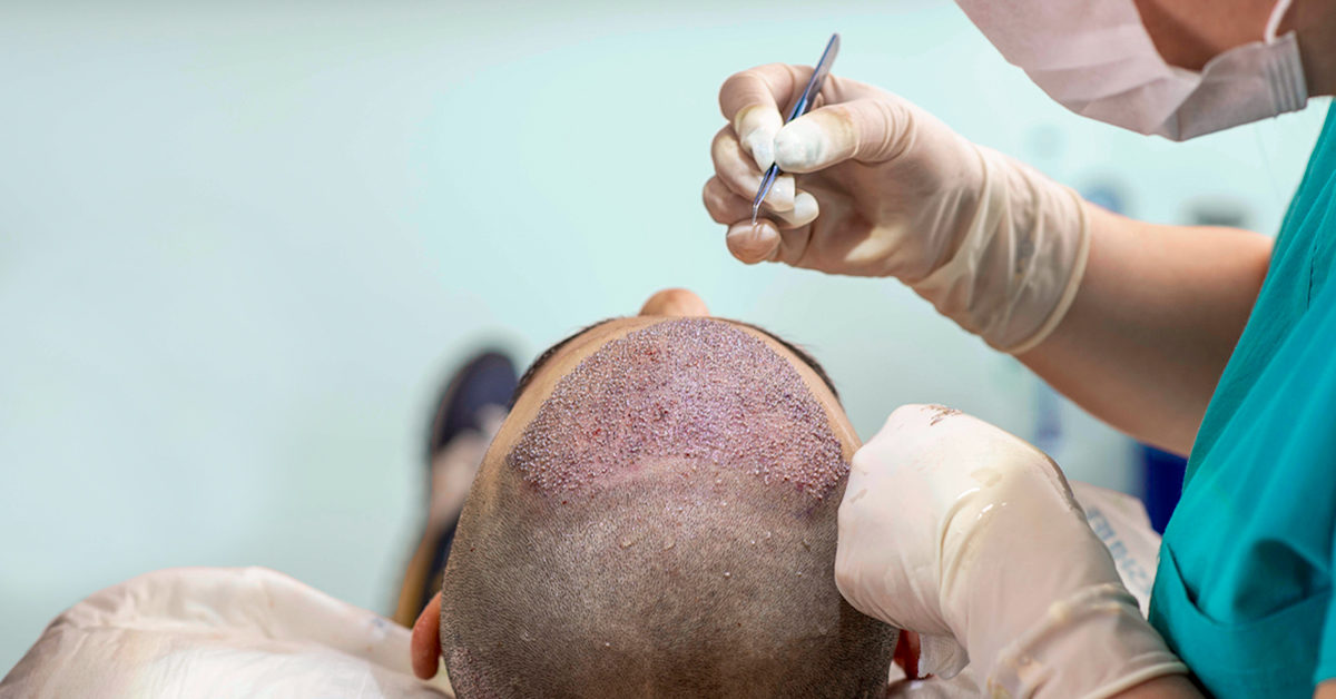 Chitwan Medical College offers bank loan for hair transplant