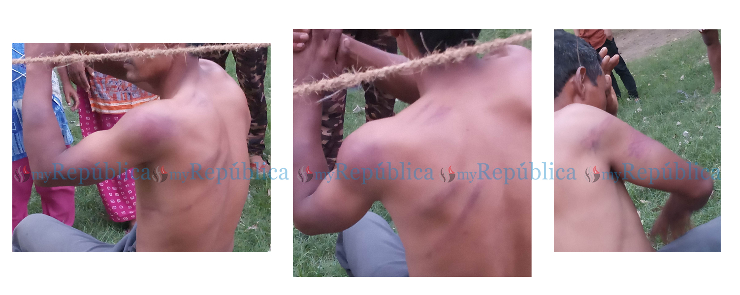 Police beating leaves a COVID-19 patient in Surkhet with a fractured hand