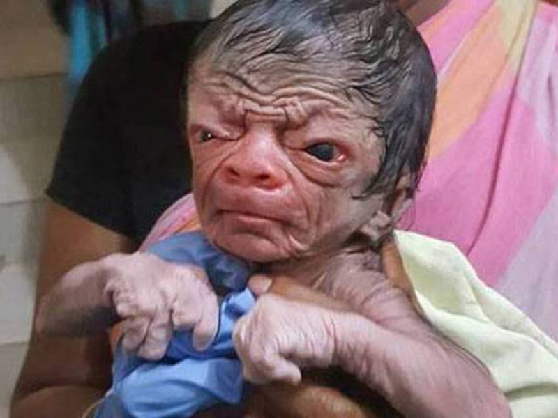 Bangladesh’s Benjamin Button: Medical condition makes newborn look like 80-yr-old