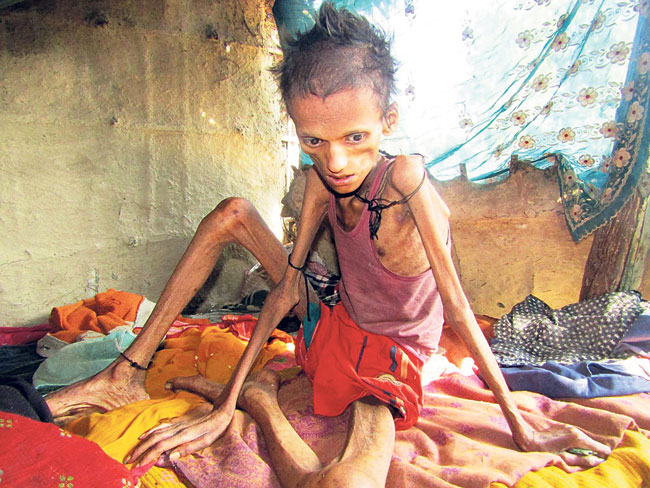 Malnutrition still rife in Karnali children