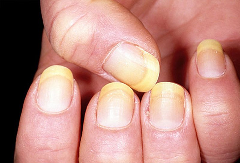 My City - What causes yellow nails and how to cure this problem