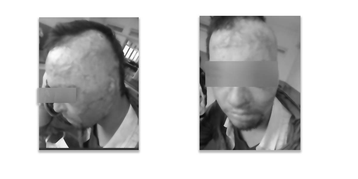 Family of male acid attack victim runs out of money; despite constant calls for help, authorities choose to stay unreceptive observers