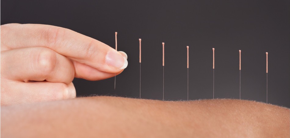 A tale of acupuncture cure