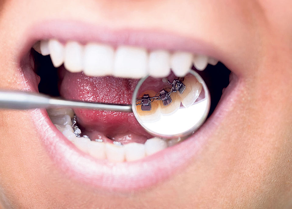 The basics of braces