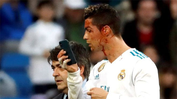 Ronaldo borrows doctor's phone to check facial injury on pitch