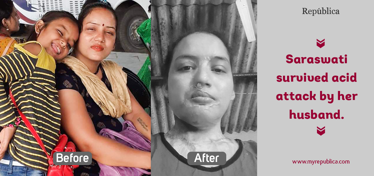 Nepali woman in Bangalore finds hope after horrific acid attack by her husband