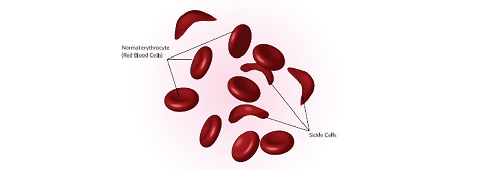 Sickle Cell anemia rampant among Tharus in Western Terai, 11% of the indigenous community have the disease