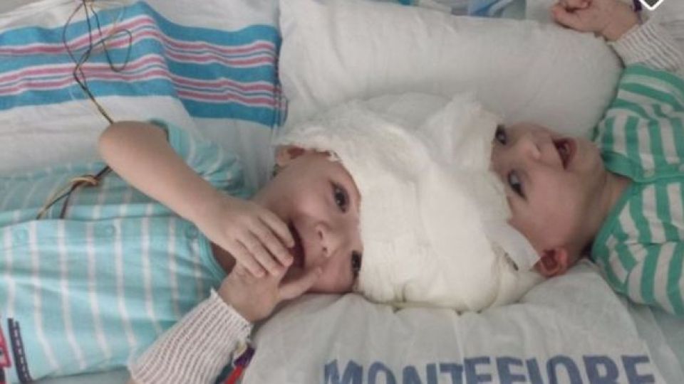 Conjoined twins successfully separated in 20-hr surgery